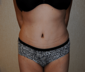 Tummy tuck front after