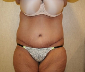 Tummy tuck front after