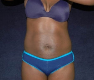 Tummy tuck front before