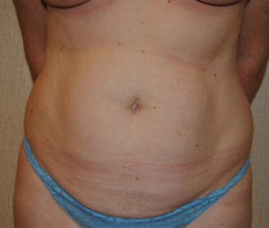 Tummy tuck front before