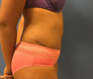 Tummy tuck side after