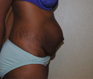 Tummy tuck side before