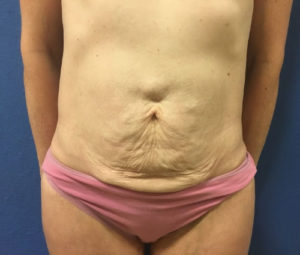 47 yo 265 low plus with tummy tuck and hernia repair Before