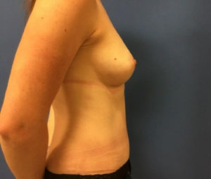 37 yo 140 low with tummy tuck