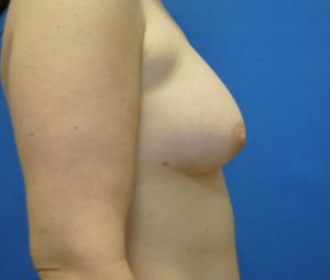 Breast Augmentation with Fat Grafting