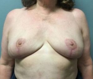Breast reduction after