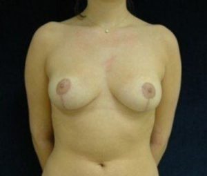 Breast reduction after