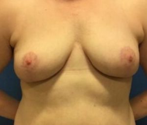 Breast Lift After