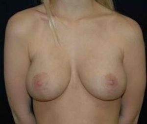 Breast reduction after