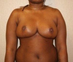 Breast reduction after