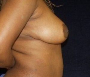 Breast reduction after