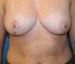 Breast reduction after
