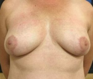 Breast reduction after
