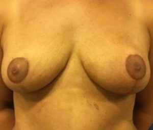 Breast Reduction After