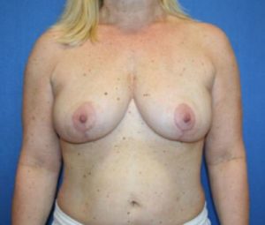 Breast Reduction After
