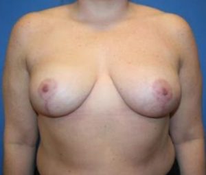 Breast Reduction After