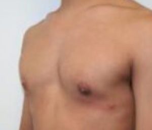 Gynecomastia After