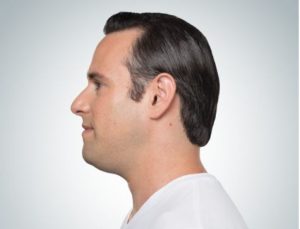 Kybella