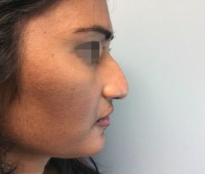 Rhinoplasty DC nose surgery before