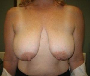 Breast Lift Before