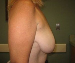 Breast Lift