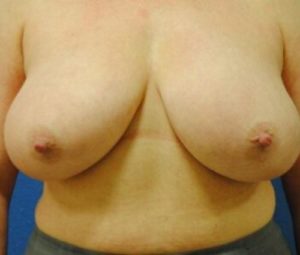 Breast reduction before