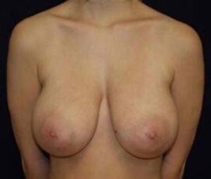 Breast reduction before