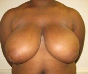 Breast reduction before