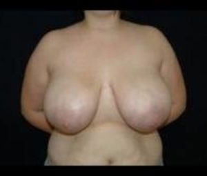 Breast Reduction