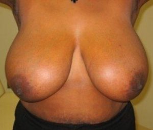 Breast reduction before