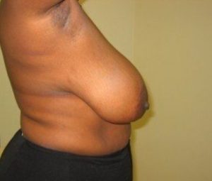 Breast reduction before