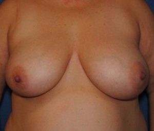 Breast reduction before