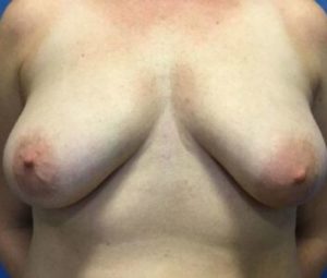 Breast reduction before