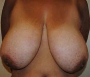 Breast reduction before