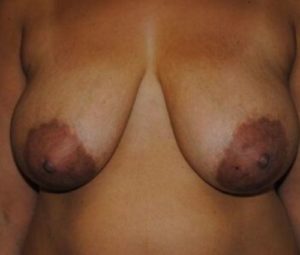 Breast Reduction Before