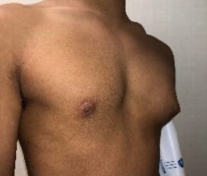Gynecomastia Before