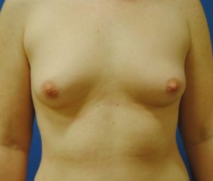 Before Breast Augmentation with Fat Grafting