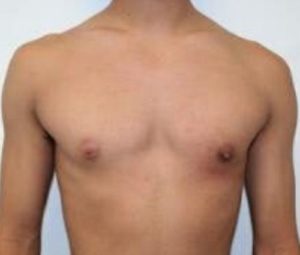 Gynecomastia After