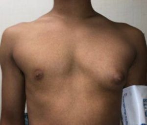 Gynecomastia Before