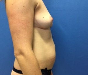 37 yo 140 low with tummy tuck