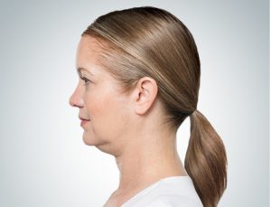 Kybella