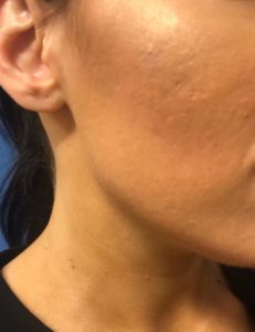 chin-before-e1529005759384 (1)
