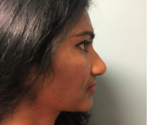 Rhinoplasty