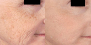 Microneedling1a-1