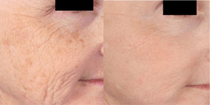 Microneedling
