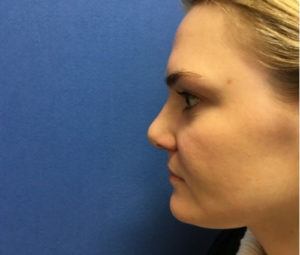 Rhinoplasty