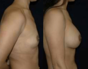 DC Breast Implants