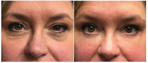 Blepharoplasty Before & After