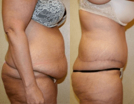 DC Tummy Tuck