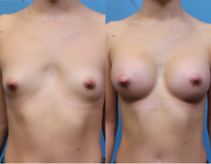 DC Plastic Surgeons Breast Augmentation Example